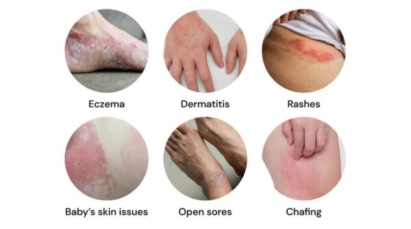 tentoes healer