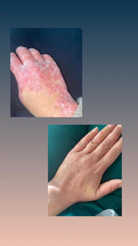 Psoriasis & Eczema Ointment - 30GRAM - Natural & Effective
