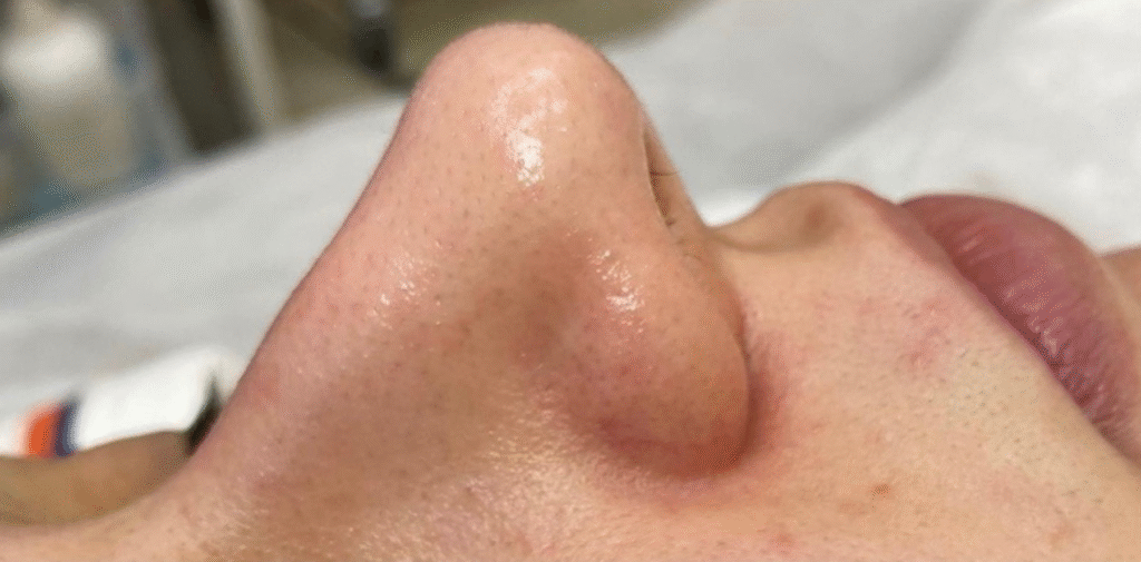 How to Remove Blackheads