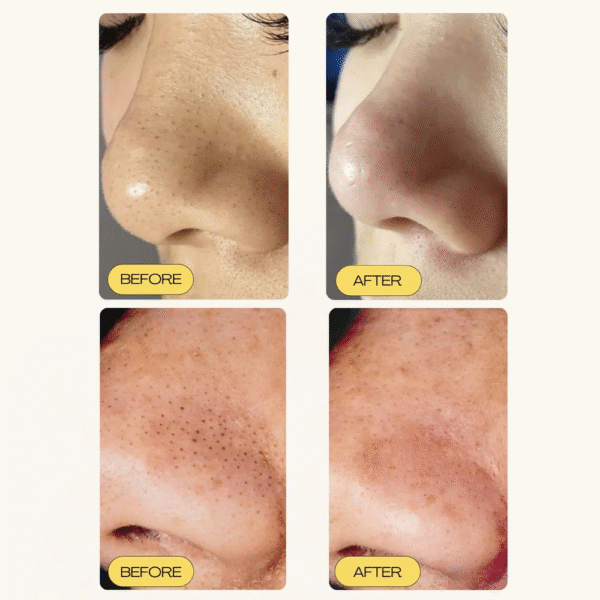 Blackhead Removal Strip - Image 6
