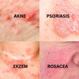 Derm Relief Balm for Eczema