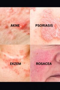 Alt text: Relief Balm for Eczema and Psoriasis in black tin