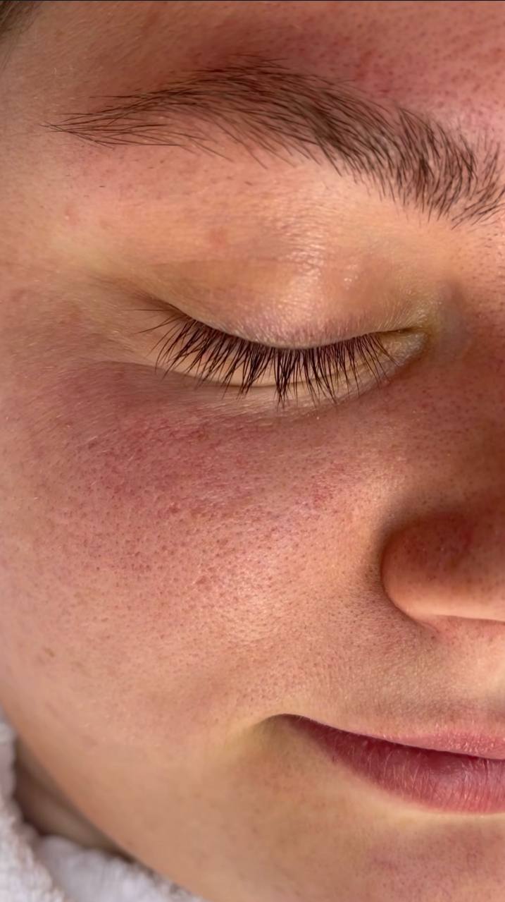 how to clear clogged pores on face
