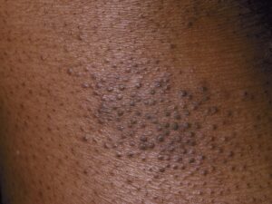 Keratosis Pilaris Treatment at Home: 6 Effective Remedies
