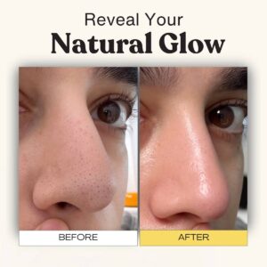 Blackhead Removal And Deep Pore Cleanser