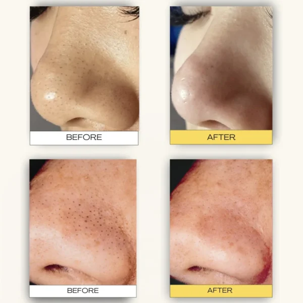 Pore Cleanser - hilft, Haut zu reinigen und zu erfrischen - Image 3