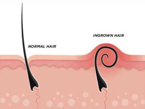 Ingrown Hair Serum Roller – Exfoliating Aftershave 50ml