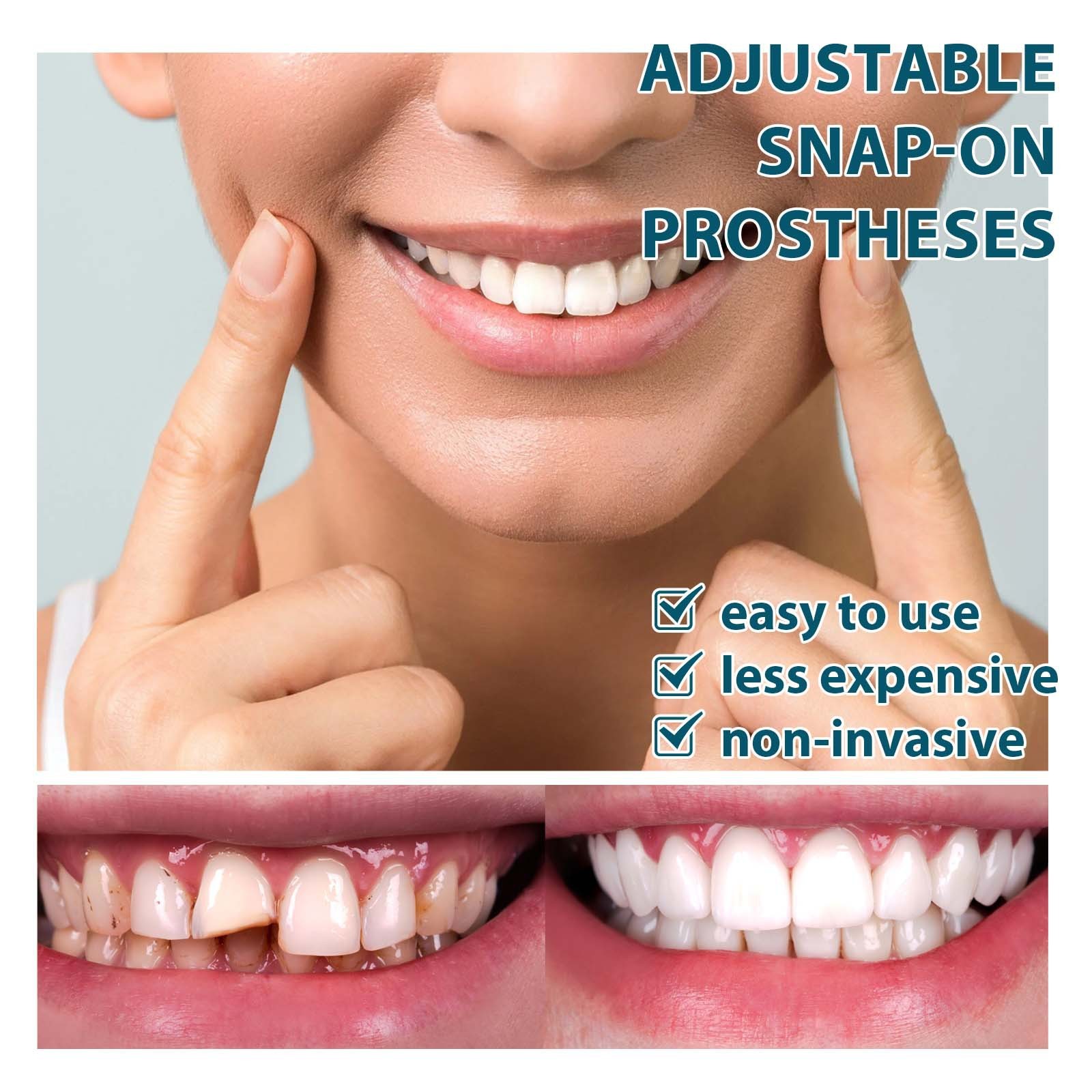 Snap-On Cosmetic Smile Covers (Non-Medical)