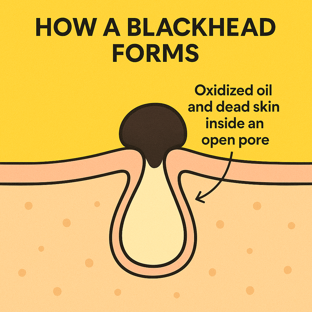 blackhead removal guide