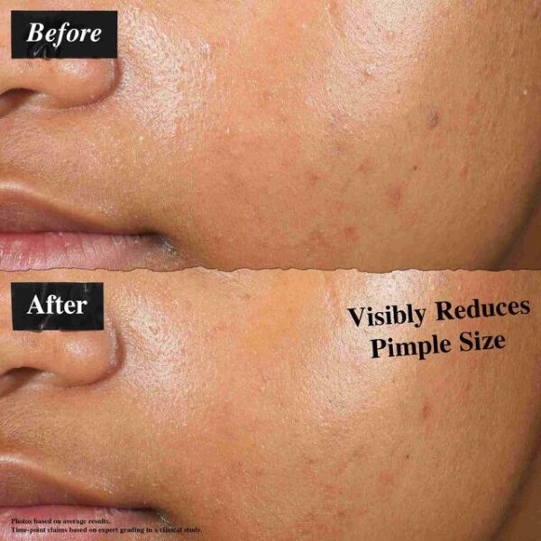 Magic Liquid Pimple Patch - Image 2